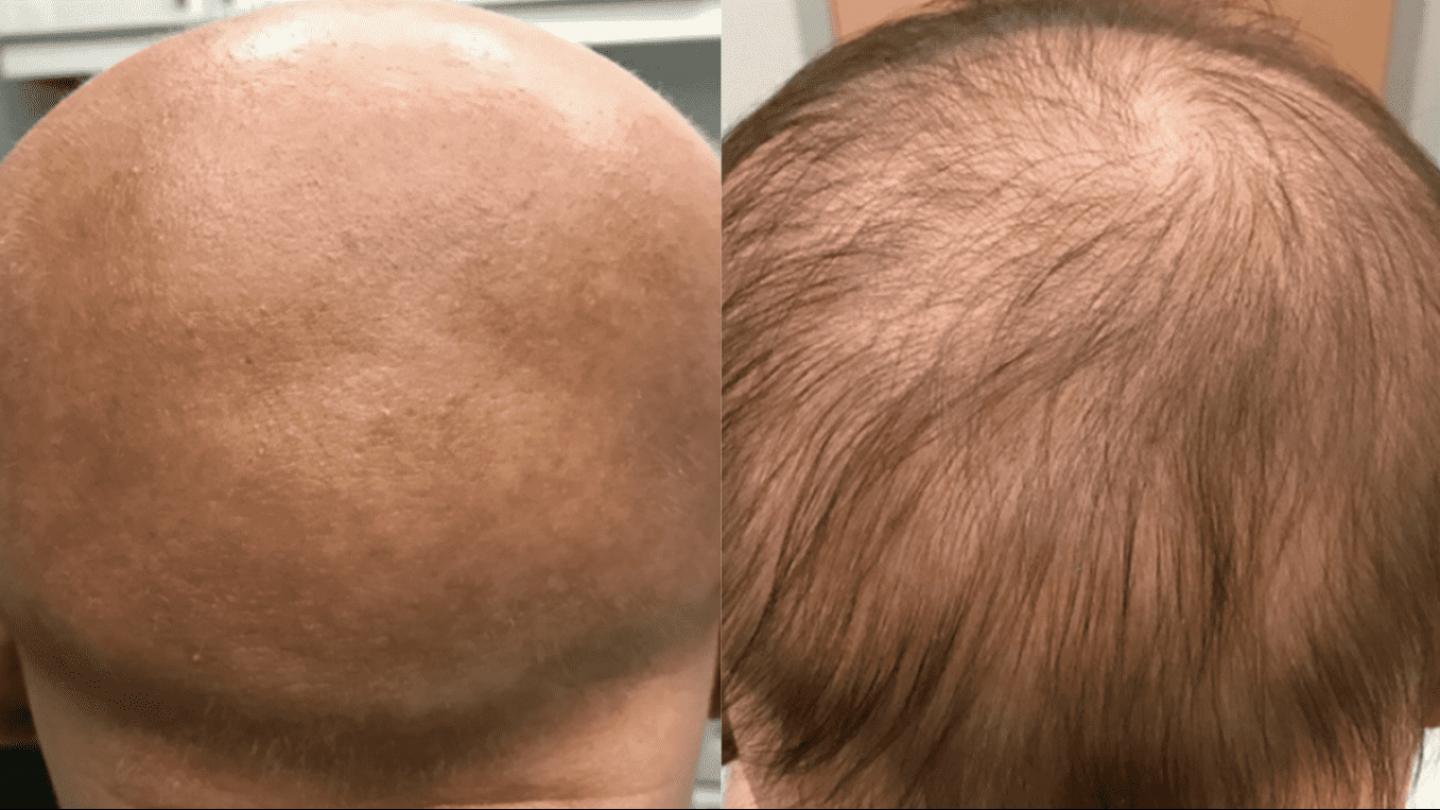 Hair growing effect in a teenager