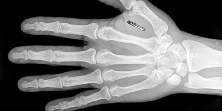 Chip implantado en la mano